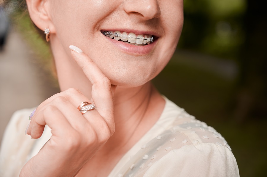 How to Eat Comfortably Even if You Have Dental Braces