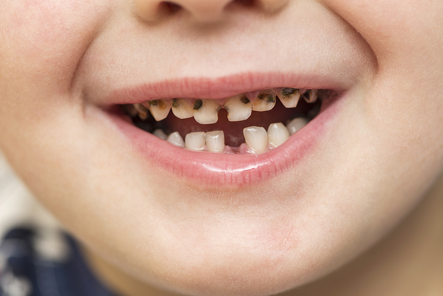 Step-By-Step Guide to Preventing Tooth Decay