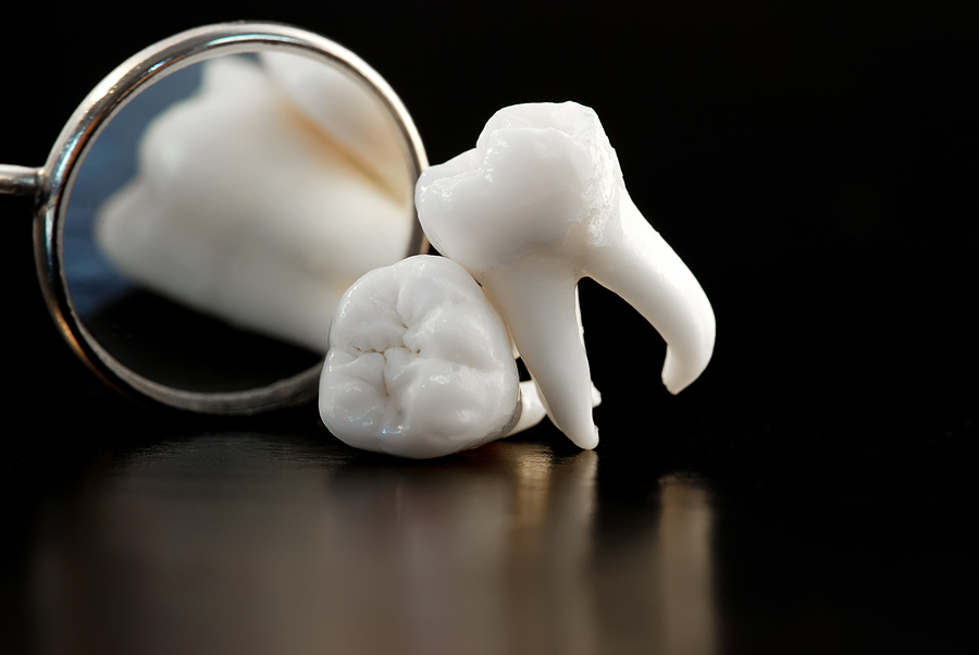 Common Indications That You Should Have Your Wisdom Teeth Removed